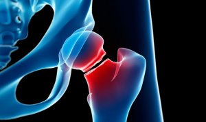 Osteoporosis