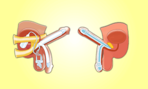 Types of penile implants